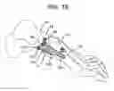 Fig. 10 - Bending tool and method for reshaping a bone plate