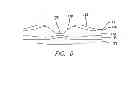 Fig. 07 - Visual prosthesis with an improved electrode array adapted for foveal stimulation