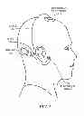 Fig. 04 - Electrically evoked brainstem response measurements via implant prosthesis