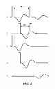 Fig. 06 - Electrically evoked brainstem response measurements via implant prosthesis