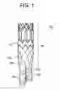 Fig. 02 - Endoprothesis delivery system