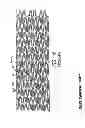 Fig. 03 - Intravascular stent