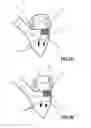 Fig. 03 - MITRAL HEART VALVE PROSTHESIS AND ASSOCIATED DELIVERY CATHETER