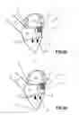 Fig. 04 - MITRAL HEART VALVE PROSTHESIS AND ASSOCIATED DELIVERY CATHETER