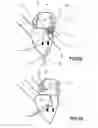 Fig. 07 - MITRAL HEART VALVE PROSTHESIS AND ASSOCIATED DELIVERY CATHETER