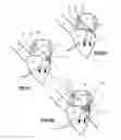 Fig. 08 - MITRAL HEART VALVE PROSTHESIS AND ASSOCIATED DELIVERY CATHETER