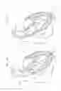 Fig. 03 - Transapical method of delivering prosthetic heart valve