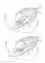 Fig. 05 - Transapical method of delivering prosthetic heart valve