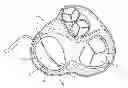 Fig. 01 - Devices and methods for treating valvular regurgitation