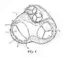 Fig. 02 - Devices and methods for treating valvular regurgitation