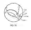 Fig. 09 - Devices and methods for treating valvular regurgitation