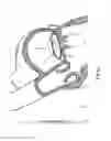 Fig. 11 - Heart valve repair device