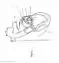 Fig. 33 - Heart valve repair device