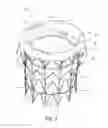 Fig. 02 - Vascular implant