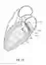 Fig. 37 - Vascular implant