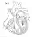 Fig. 22 - Blood flow controlling apparatus