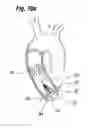 Fig. 25 - Blood flow controlling apparatus