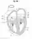 Fig. 43 - Blood flow controlling apparatus