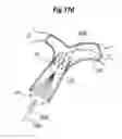 Fig. 61 - Blood flow controlling apparatus