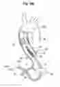 Fig. 64 - Blood flow controlling apparatus