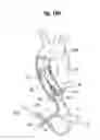 Fig. 65 - Blood flow controlling apparatus