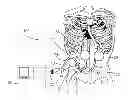 Fig. 01 - Bi-Ventricular Percutaneous Cable