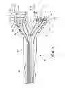 Fig. 05 - Bi-Ventricular Percutaneous Cable