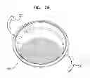 Fig. 30 - Accommodative intraocular lens