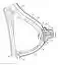 Fig. 01 - Implantable prosthesis for reconstruction of an anatomical feature