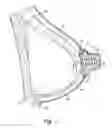 Fig. 02 - Implantable prosthesis for reconstruction of an anatomical feature