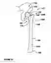 Fig. 02 - Modular, adjustable, prosthetic, hip/shoulder spacer