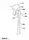 Fig. 03 - Modular, adjustable, prosthetic, hip/shoulder spacer