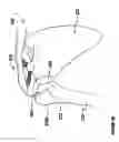 Fig. 06 - Modular, adjustable, prosthetic, hip/shoulder spacer