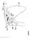 Fig. 07 - Modular, adjustable, prosthetic, hip/shoulder spacer