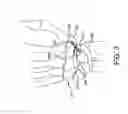 Fig. 04 - Fusion implant