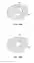 Fig. 12 - Fusion implant