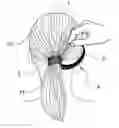 Fig. 01 - Pony Tail Wrap