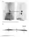 Fig. 07 - Compounds for binding to the platelet specific glycoprotein IIB/IIIA and their use for imaging of thrombi