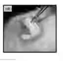 Fig. 01 - Stimuli responsive adhesive gel for removal of foreign particles from soft tissue