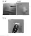 Fig. 08 - Stimuli responsive adhesive gel for removal of foreign particles from soft tissue