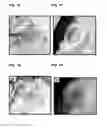 Fig. 10 - Stimuli responsive adhesive gel for removal of foreign particles from soft tissue