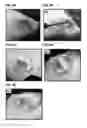 Fig. 11 - Stimuli responsive adhesive gel for removal of foreign particles from soft tissue