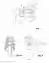 Fig. 08 - OPTICAL TROCAR ASSEMBLY AND SYSTEM