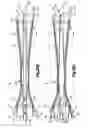 Fig. 46 - Expandable dilator