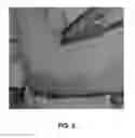 Fig. 03 - PREOPERATIVE IDENTIFICATION OF PERFORATOR VESSELS IN FLAPS TO BE USED IN RECONSTRUCTIVE SURGERY
