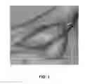 Fig. 04 - PREOPERATIVE IDENTIFICATION OF PERFORATOR VESSELS IN FLAPS TO BE USED IN RECONSTRUCTIVE SURGERY