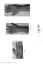 Fig. 08 - Wearable device for improving tactile sensitivity