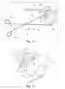 Fig. 02 - DEVICE FOR THE TREATMENT OF AN OCULAR DISEASE