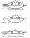 Fig. 04 - Reduced pressure augmentation of microfracture procedures for cartilage repair
