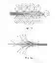 Fig. 06 - Device for the treatment of an ocular disease